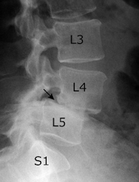 L4 spondylolisthesis of the low back